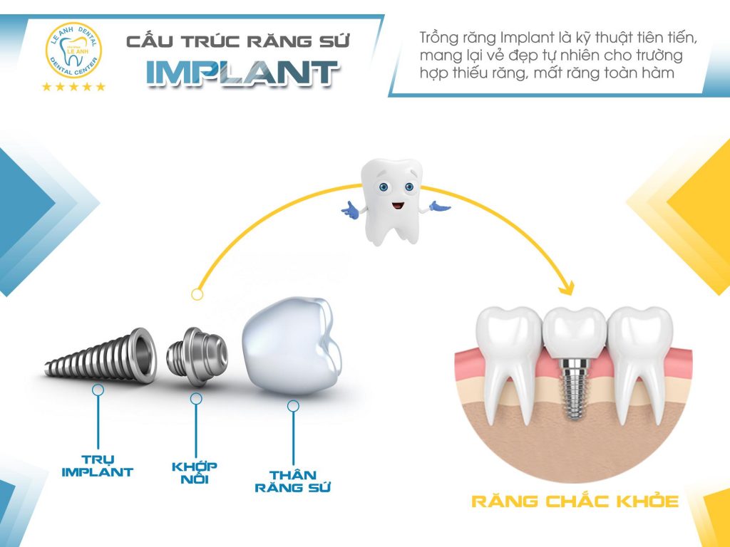 trồng răng implant - cấu trúc răng implant