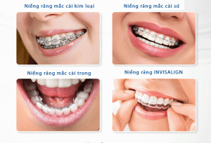 niềng răng thẩm mỹ 02 - các loại mắc cài