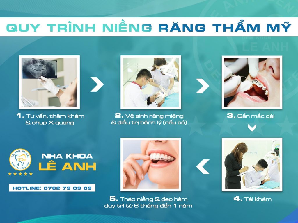 quy trình niềng răng thẩm mỹ