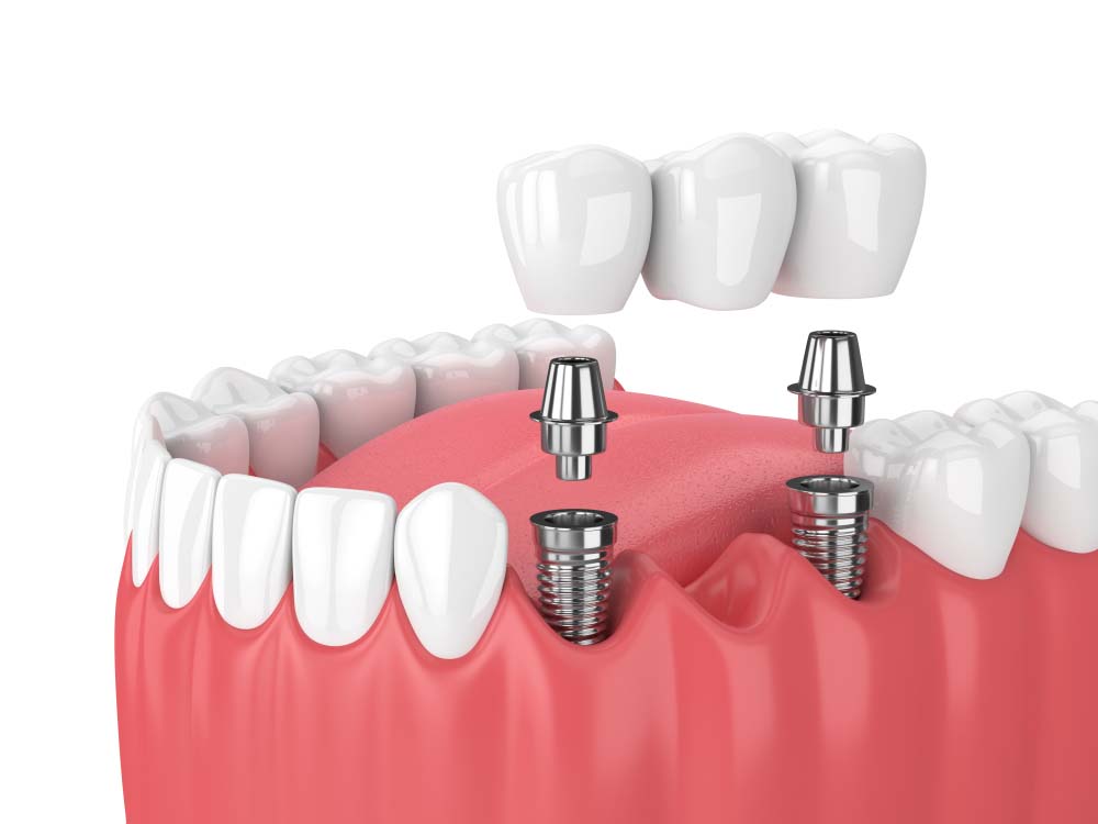 trồng răng implant 01 - tại đồng nai