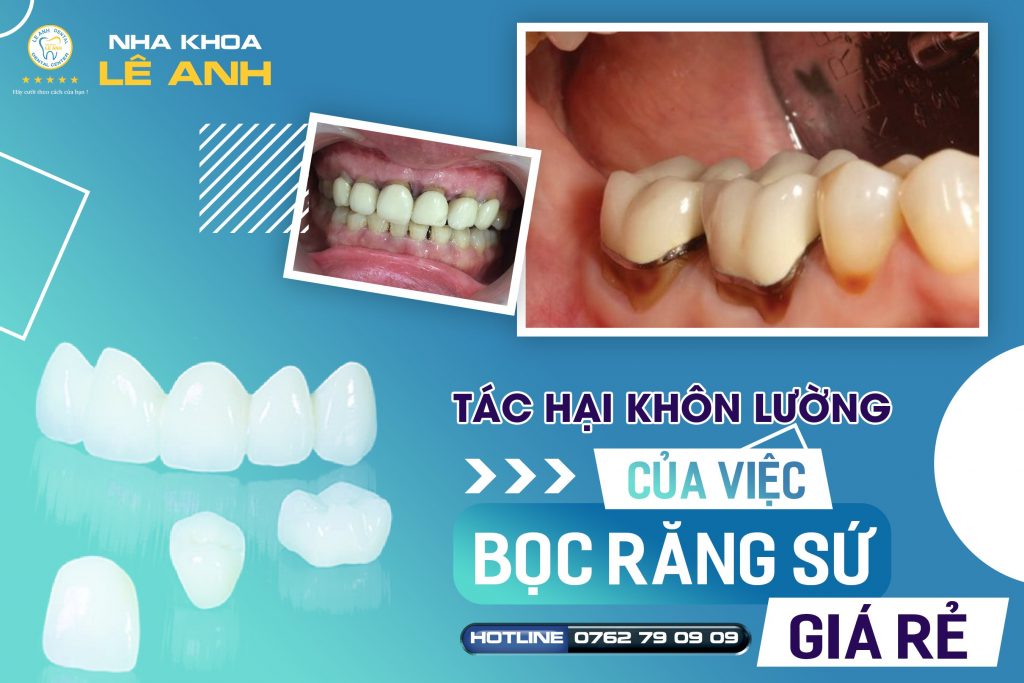 bọc răng sứ tốt nhất đồng nai