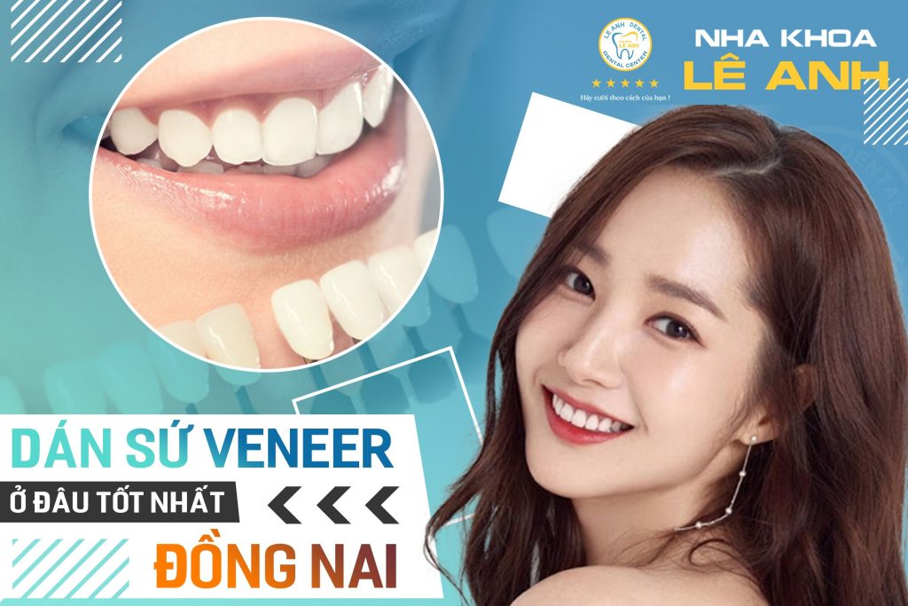 dán sứ veneer tại đồng nai