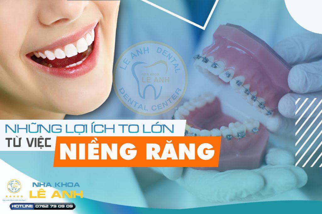 Từ việc niềng răng