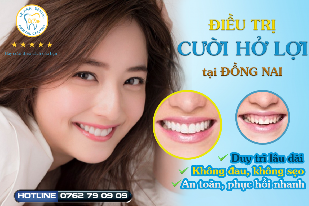 điều trị cười hở lợi uy tín tại đồng nai