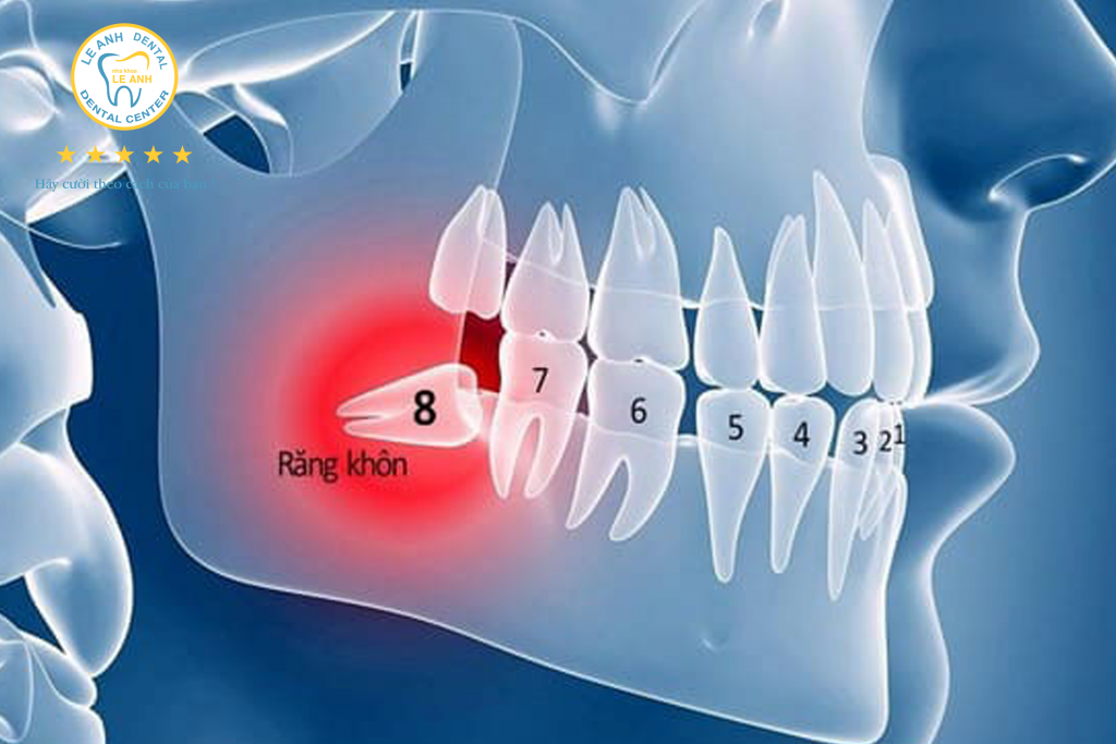 răng khôn mọc lệch