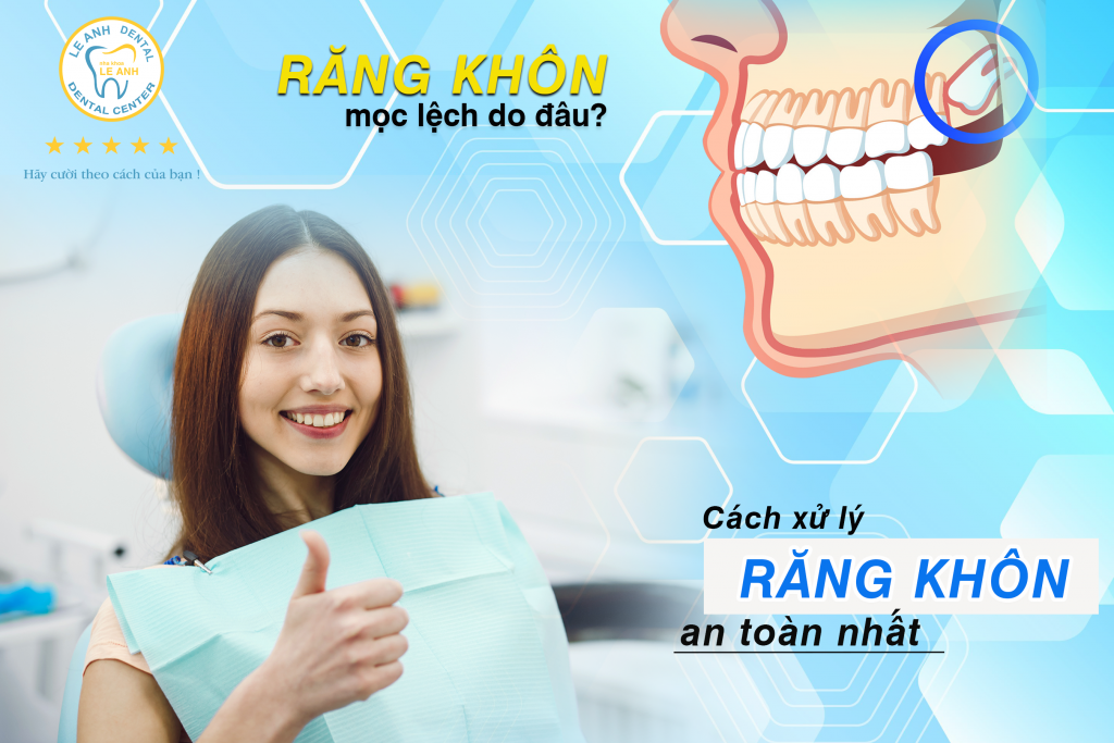 răng khôn mọc lệch