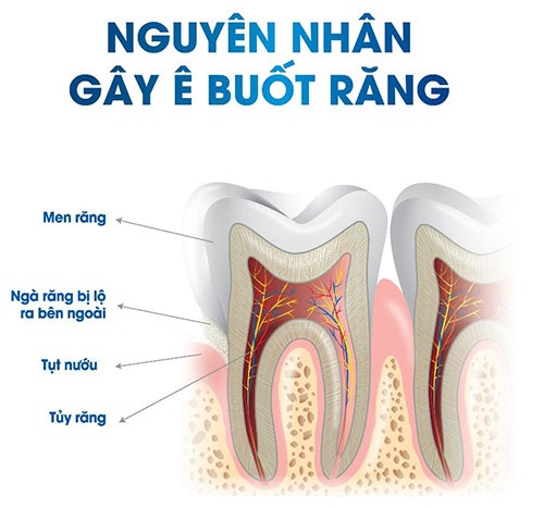 CÁCH XỬ LÝ RĂNG Ê BUỐT TẠI NHÀ