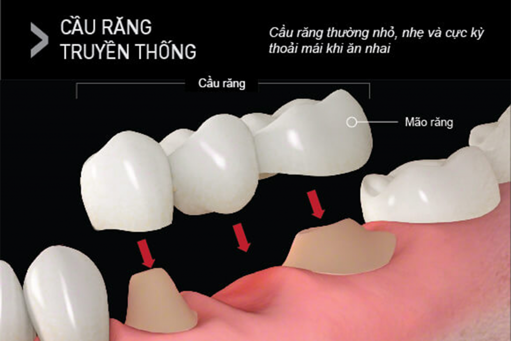 MẤT RĂNG TAI HẠI NHƯ THẾ NÀO