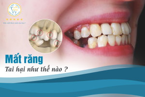 MẤT RĂNG TAI HẠI NHƯ THẾ NÀO