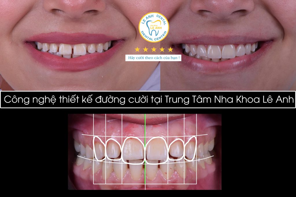 1. Công nghệ thiết kế nụ cười DSD (Digital Smile Design)