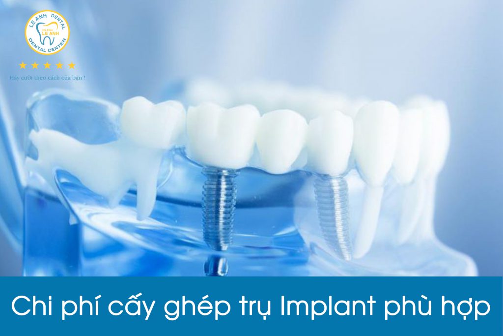 4 ĐIỀU BÁC SĨ CẢNH BÁO BẠN TRƯỚC KHI CHỌN TRỤ IMPLANT