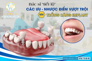 BÁC SĨ “TIẾT LỘ” CÁC ƯU – NHƯỢC ĐIỂM KHI TRỒNG RĂNG IMPLANT