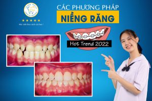 CÁC PHƯƠNG PHÁP NIỀNG RĂNG HOT TREND 2022