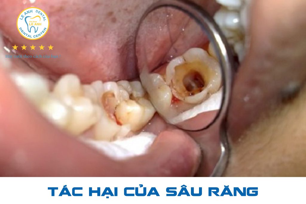 2. Tác hại của sâu răng