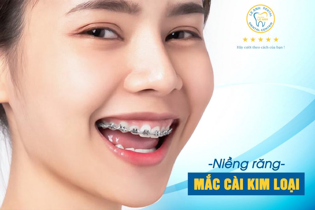 Niềng răng mắc cài kim loại