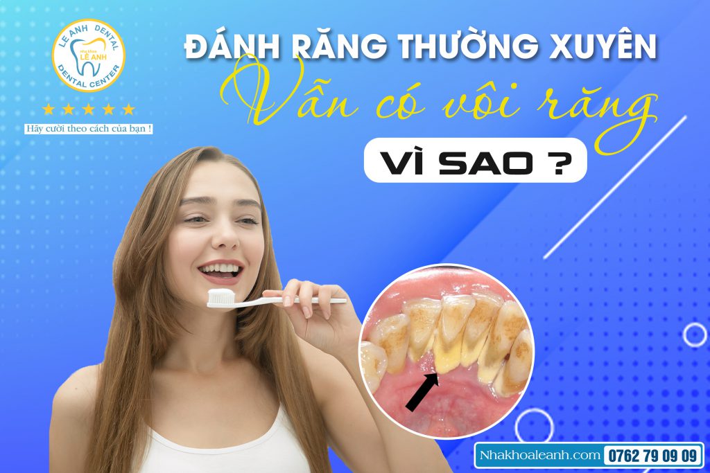 VÌ SAO ĐÁNH RĂNG THƯỜNG XUYÊN MÀ VẪN CÓ VÔI RĂNG?