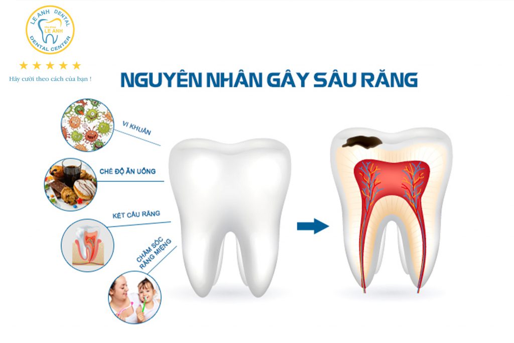 1. Sâu răng – Nguyên nhân do đâu?