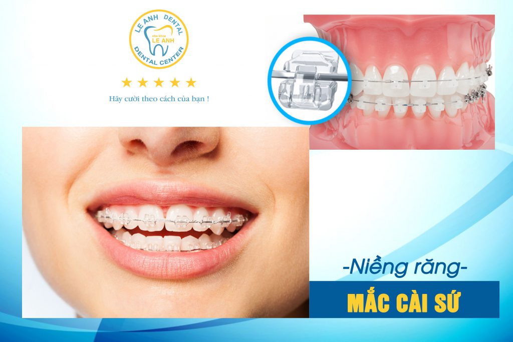 Niềng răng mắc cài sứ