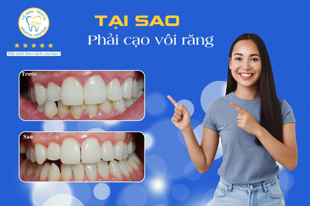 3. Tại sao phải cạo vôi răng