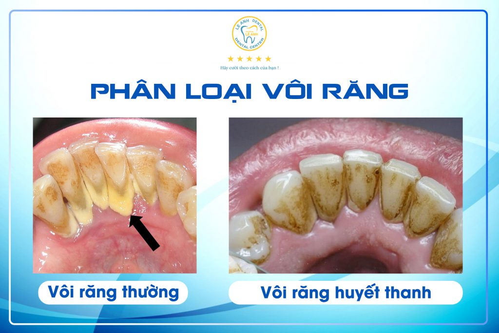 1. Phân loại vôi răng