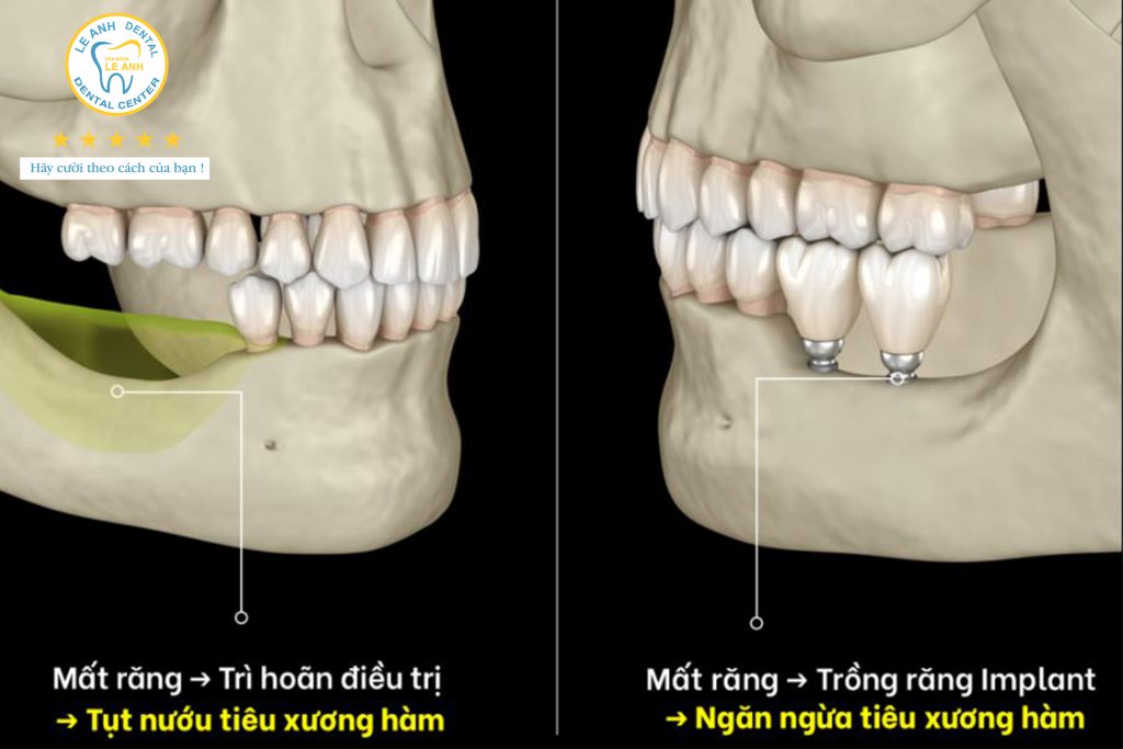 3. Hạn chế tiêu xương 3. Hạn chế tiêu xương