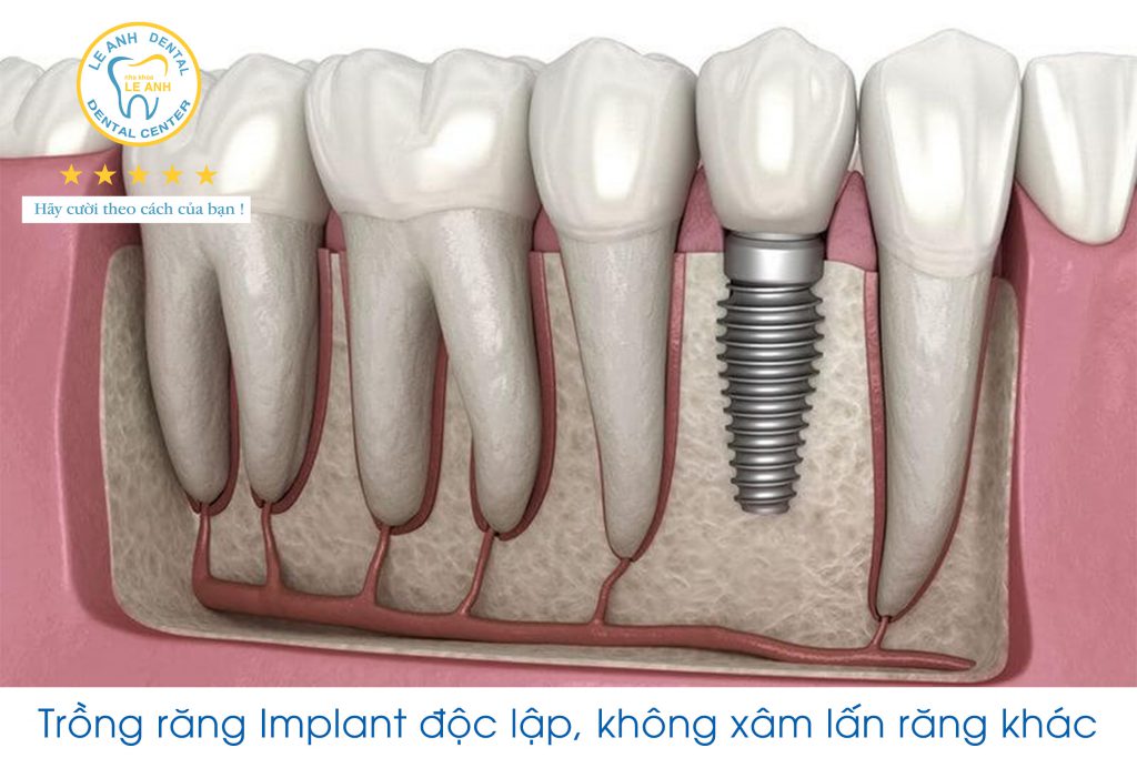 4. Trồng răng độc lập, không xâm lấn răng khác