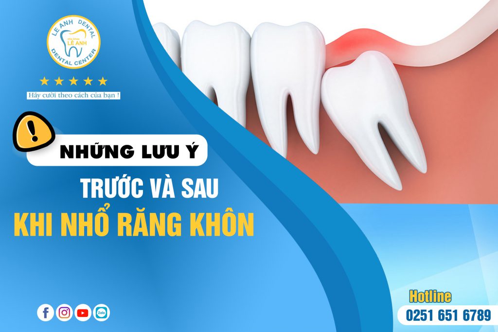 NHỮNG LƯU Ý TRƯỚC VÀ SAU KHI NHỔ RĂNG KHÔN