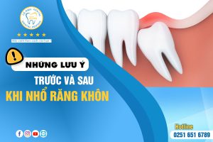 NHỮNG LƯU Ý TRƯỚC VÀ SAU KHI NHỔ RĂNG KHÔN