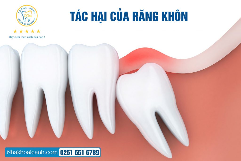 1. Tác hại của răng khôn