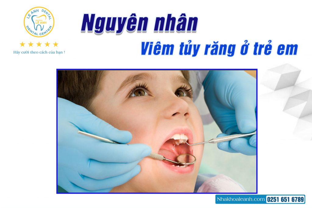 1/ Nguyên nhân dẫn răng sữa bị viêm tủy