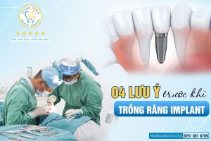 04 LƯU Ý TRƯỚC KHI TRỒNG RĂNG IMPLANT