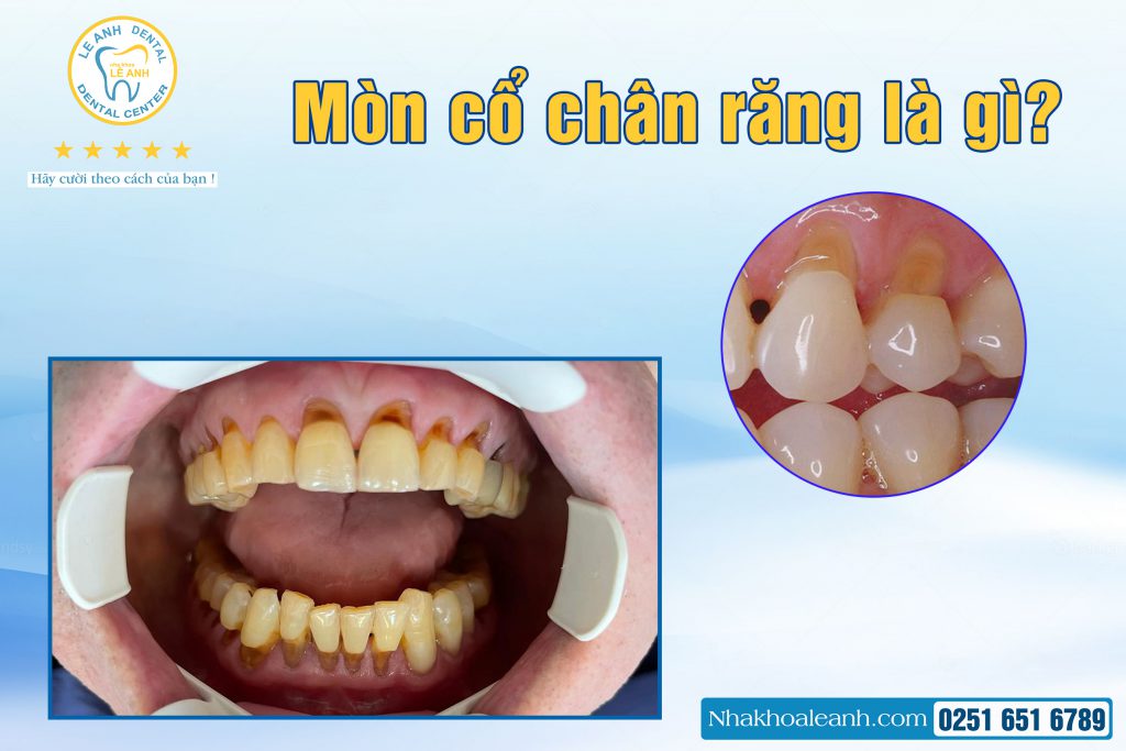 1. Mòn cổ chân răng là gì ?