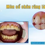 1. Mòn cổ chân răng là gì ?