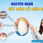 2. Nguyên nhân gây mòn cổ chân răng