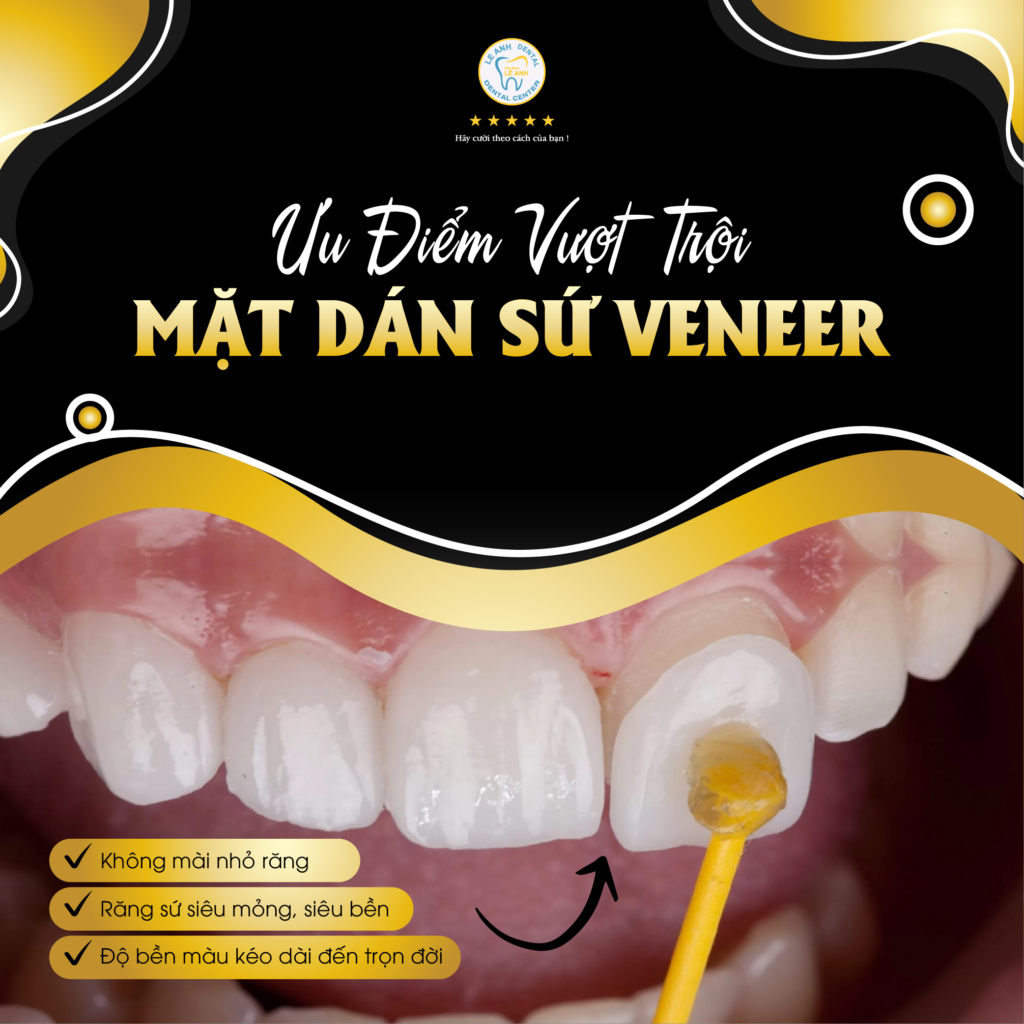 DÁN SỨ VENEER - RĂNG SỨ SIÊU MỎNG, SIÊU BỀN