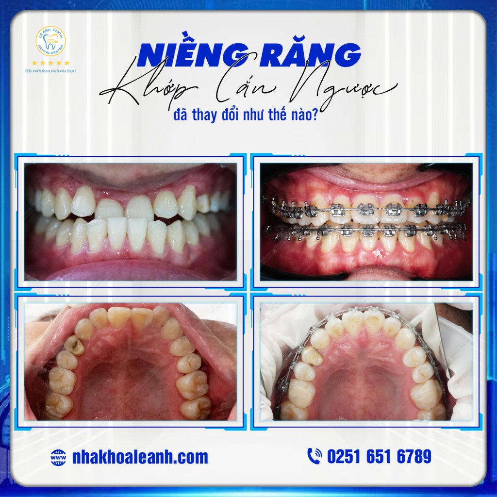 Niềng răng đã thay đổi khớp cắn ngược như thế nào ?